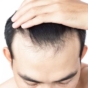 Man with receding hairline