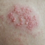 Picture of herpes virus