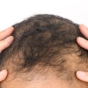 Balding man holding and scratching his head