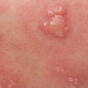 Herpes clusters