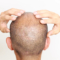 Man rubbing balding scalp