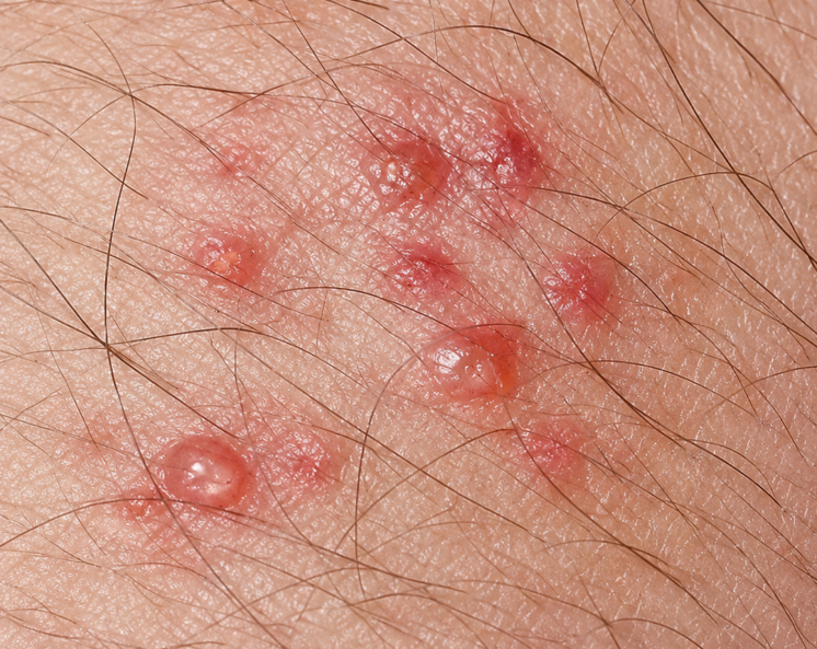 early stage of genital herpes at the beginning